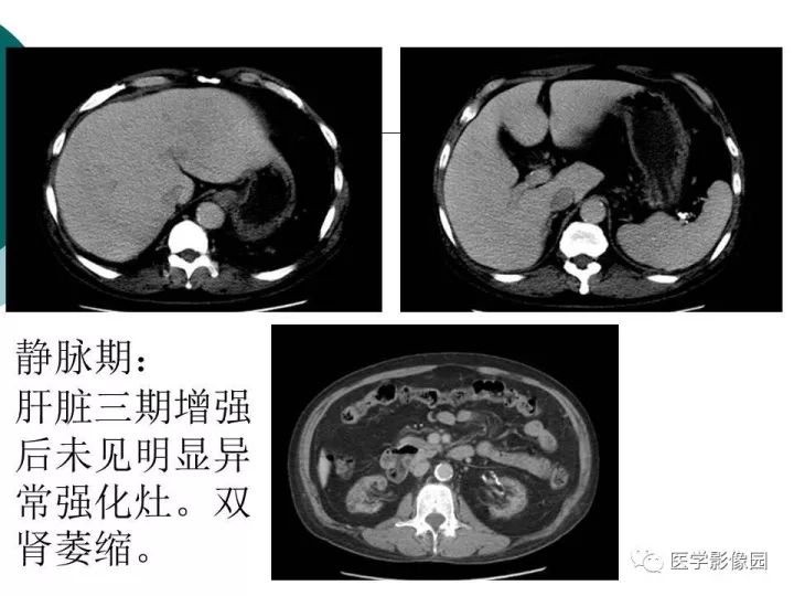 【病例】肝血色素病1例CT及MR影像表现