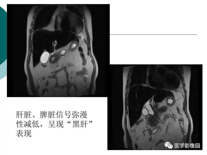 【病例】肝血色素病1例CT及MR影像表现