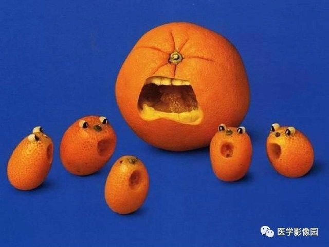 【病例】肝血色素病1例CT及MR影像表现