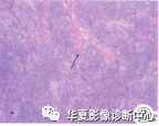 血管黏液瘤影像特征及其病理基础 血管黏液瘤影像特征及其病理基础