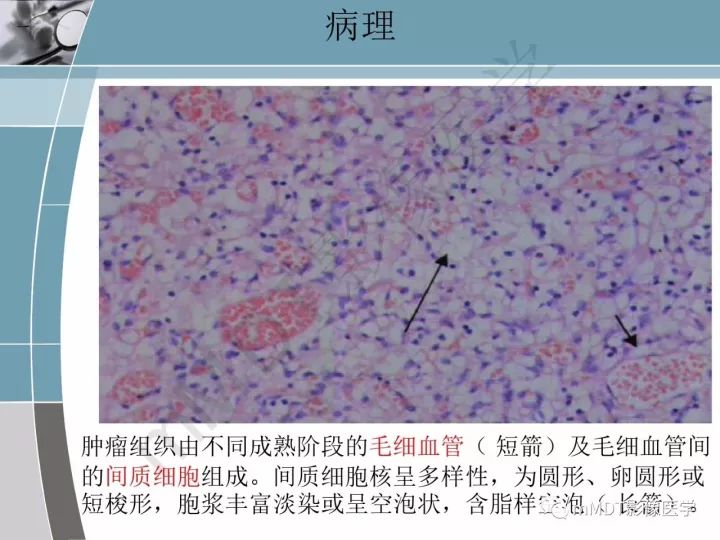 【PPT】血管母细胞瘤的MRI诊断及鉴别诊断