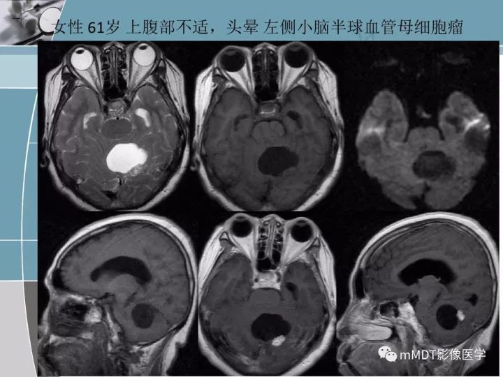 【PPT】血管母细胞瘤的MRI诊断及鉴别诊断