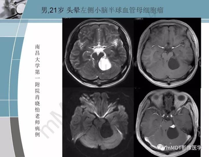 【PPT】血管母细胞瘤的MRI诊断及鉴别诊断
