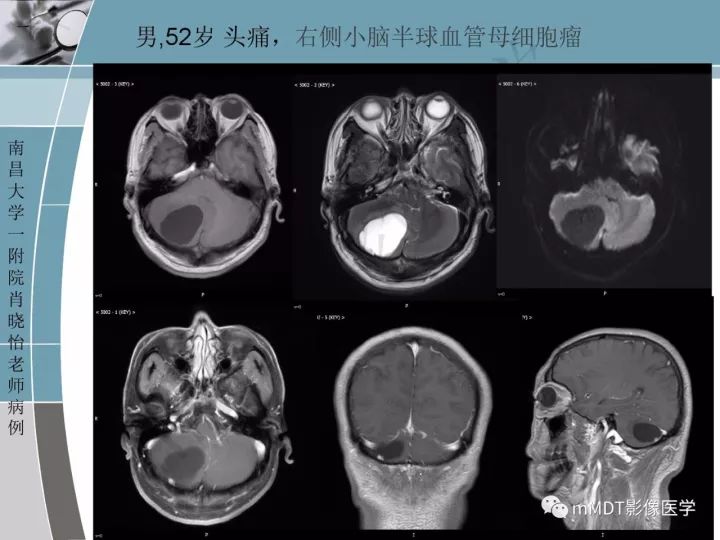 【PPT】血管母细胞瘤的MRI诊断及鉴别诊断