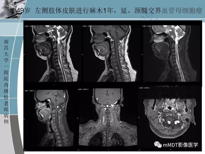 【PPT】血管母细胞瘤的MRI诊断及鉴别诊断