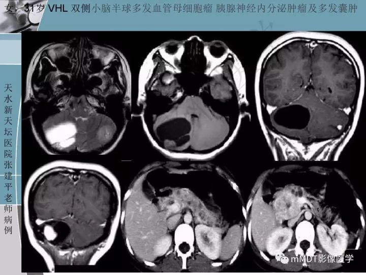 【PPT】血管母细胞瘤的MRI诊断及鉴别诊断
