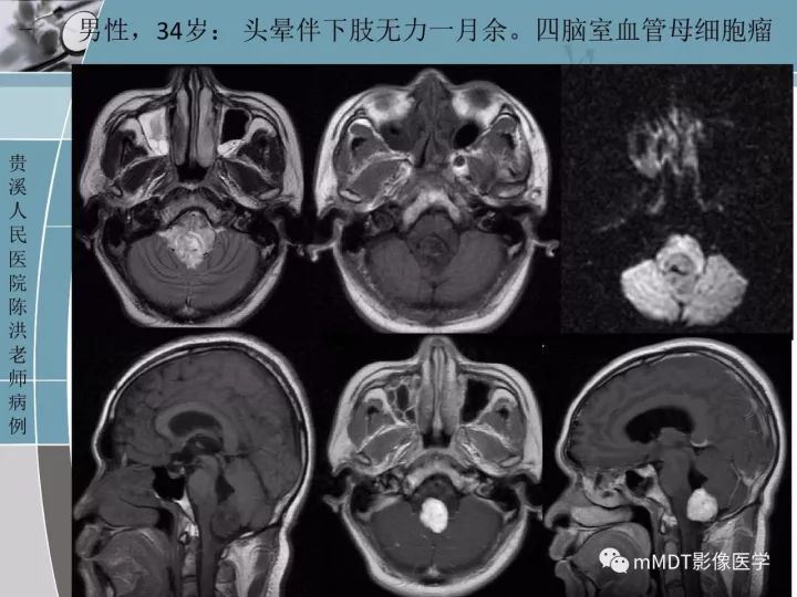 【PPT】血管母细胞瘤的MRI诊断及鉴别诊断