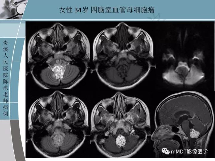 【PPT】血管母细胞瘤的MRI诊断及鉴别诊断
