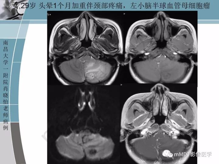 【PPT】血管母细胞瘤的MRI诊断及鉴别诊断