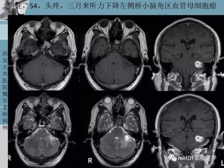 【PPT】血管母细胞瘤的MRI诊断及鉴别诊断