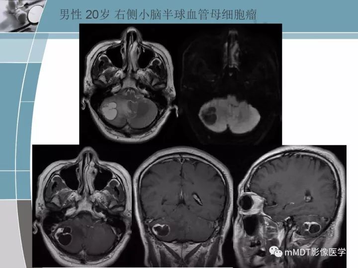 【PPT】血管母细胞瘤的MRI诊断及鉴别诊断