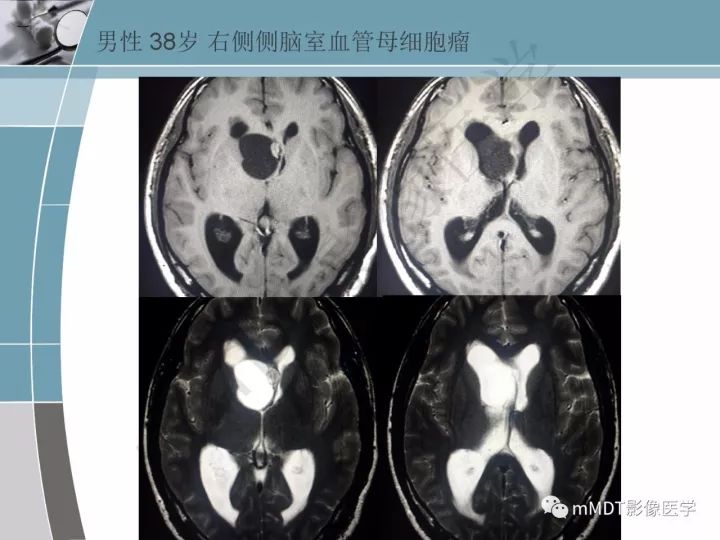 【PPT】血管母细胞瘤的MRI诊断及鉴别诊断