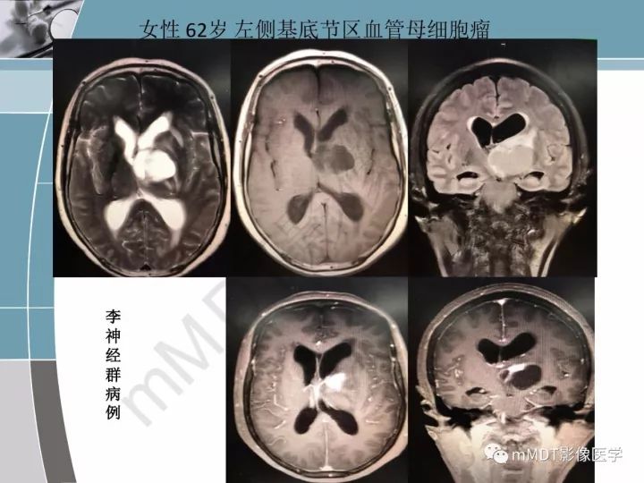 【PPT】血管母细胞瘤的MRI诊断及鉴别诊断