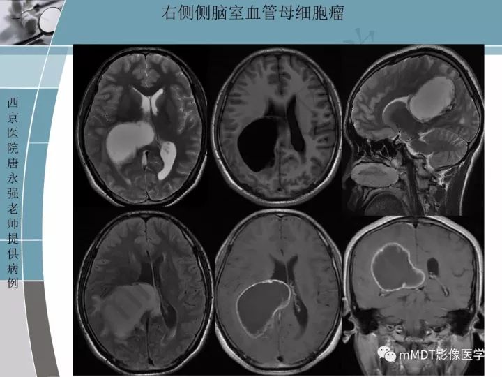 【PPT】血管母细胞瘤的MRI诊断及鉴别诊断