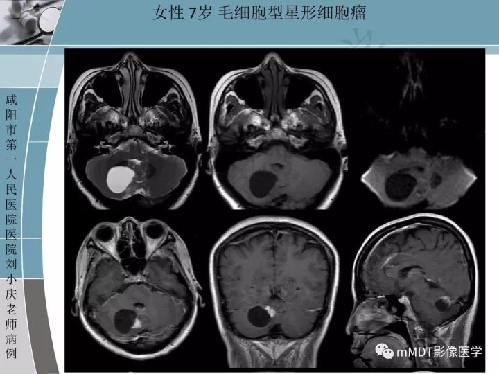 【PPT】血管母细胞瘤的MRI诊断及鉴别诊断