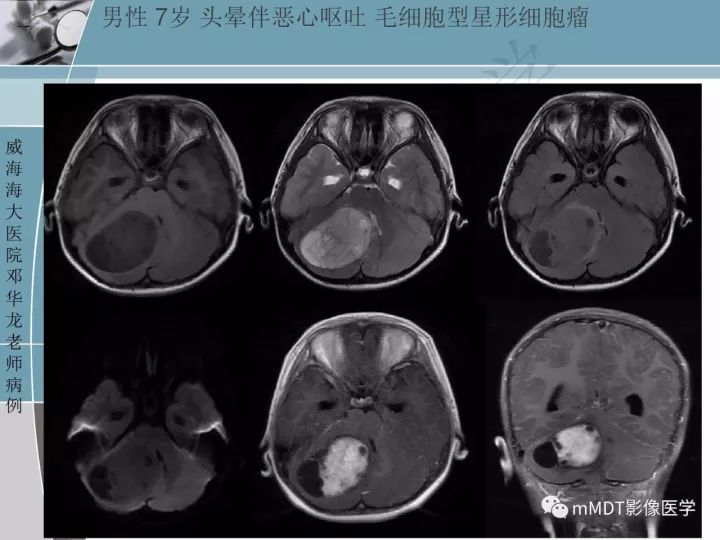 【PPT】血管母细胞瘤的MRI诊断及鉴别诊断