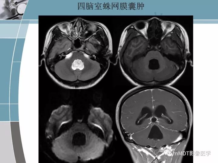 【PPT】血管母细胞瘤的MRI诊断及鉴别诊断