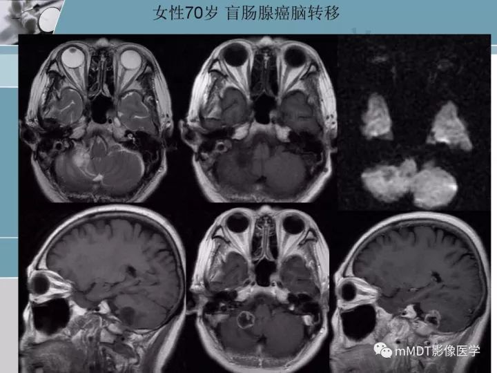 【PPT】血管母细胞瘤的MRI诊断及鉴别诊断