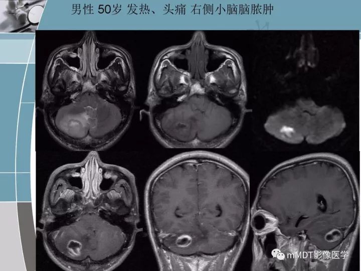 【PPT】血管母细胞瘤的MRI诊断及鉴别诊断