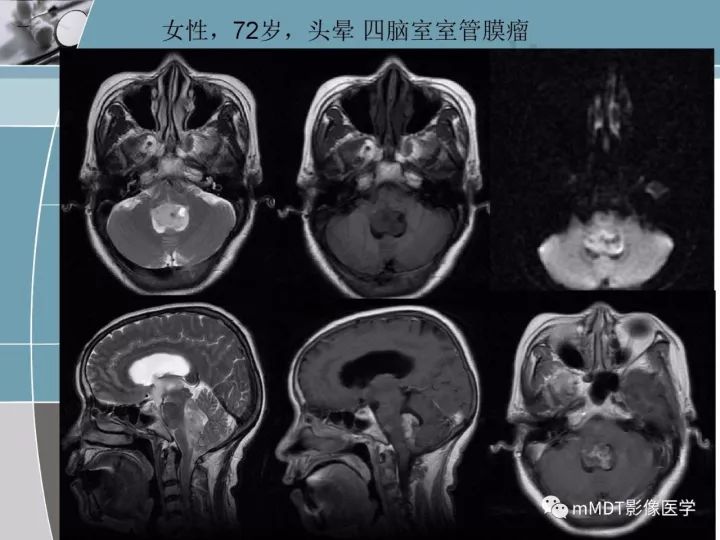 【PPT】血管母细胞瘤的MRI诊断及鉴别诊断