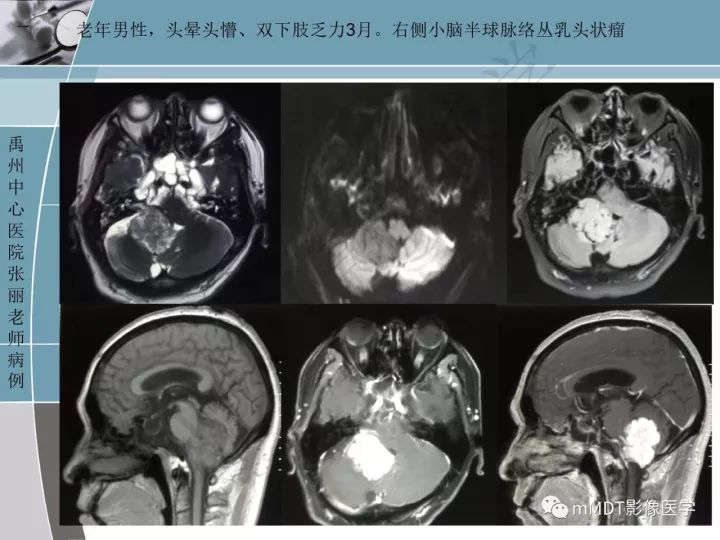 【PPT】血管母细胞瘤的MRI诊断及鉴别诊断
