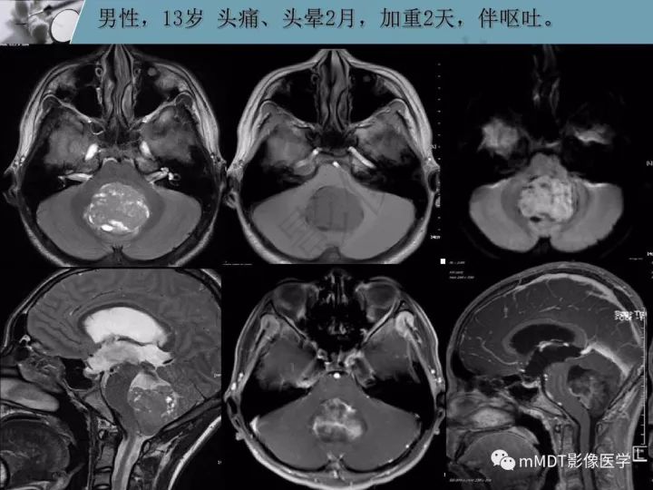 【PPT】血管母细胞瘤的MRI诊断及鉴别诊断