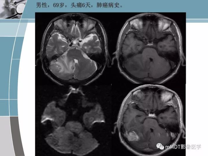 【PPT】血管母细胞瘤的MRI诊断及鉴别诊断