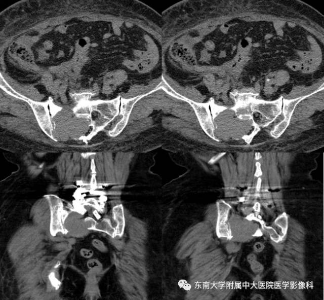 【病例】骶骨孤立性浆细胞瘤1例CT及MR影像表现