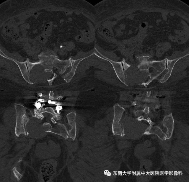 【病例】骶骨孤立性浆细胞瘤1例CT及MR影像表现