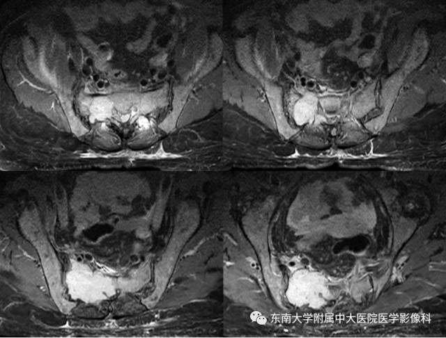 【病例】骶骨孤立性浆细胞瘤1例CT及MR影像表现