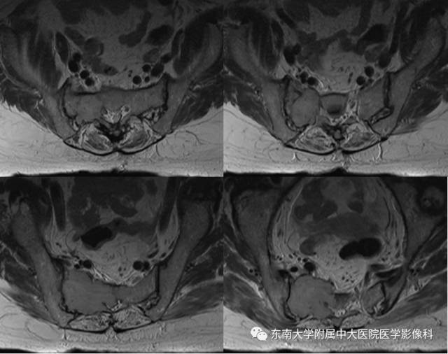 【病例】骶骨孤立性浆细胞瘤1例CT及MR影像表现