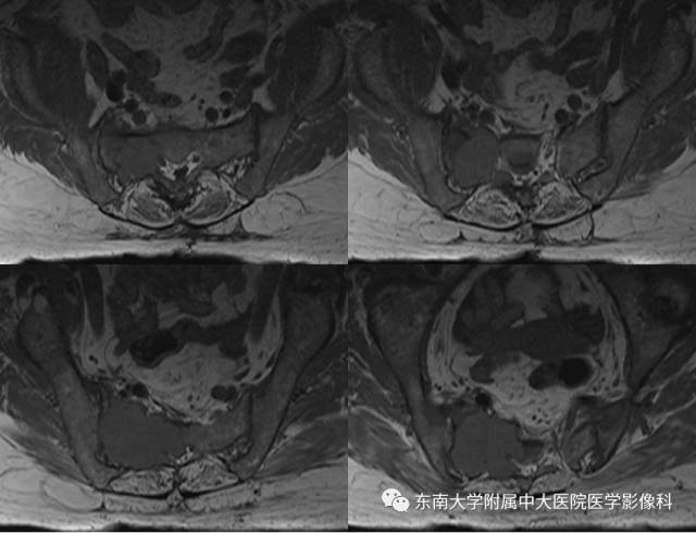 【病例】骶骨孤立性浆细胞瘤1例CT及MR影像表现
