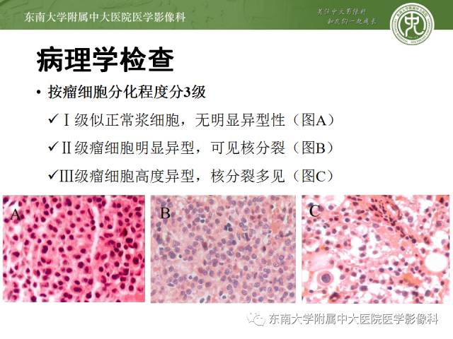 【病例】骶骨孤立性浆细胞瘤1例CT及MR影像表现