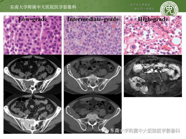 【病例】骶骨孤立性浆细胞瘤1例CT及MR影像表现