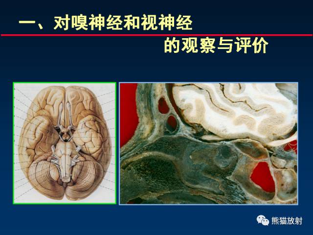 【柳澄讲坛】MR新技术在颅神经研究中的应用