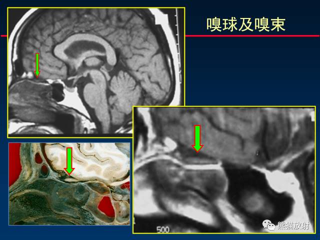 【柳澄讲坛】MR新技术在颅神经研究中的应用