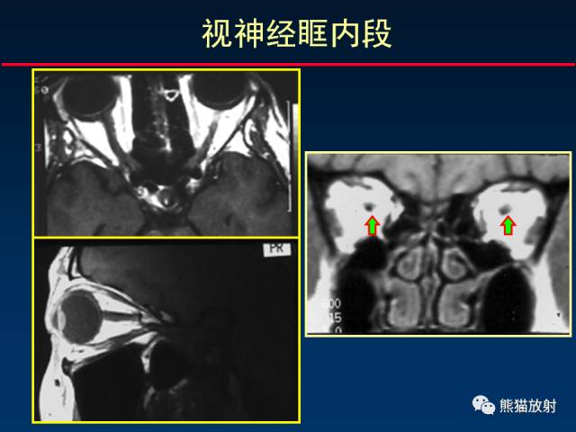 【柳澄讲坛】MR新技术在颅神经研究中的应用