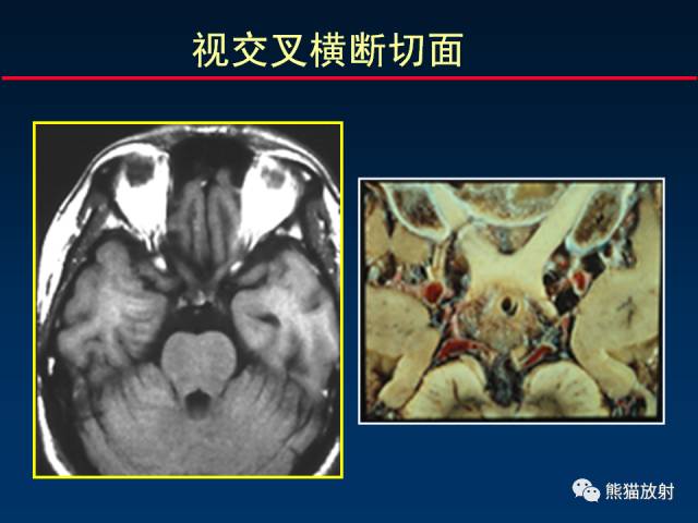 【柳澄讲坛】MR新技术在颅神经研究中的应用