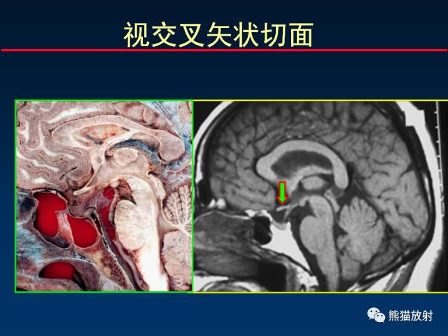 【柳澄讲坛】MR新技术在颅神经研究中的应用