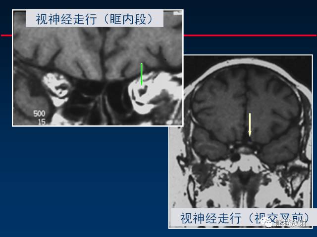 【柳澄讲坛】MR新技术在颅神经研究中的应用