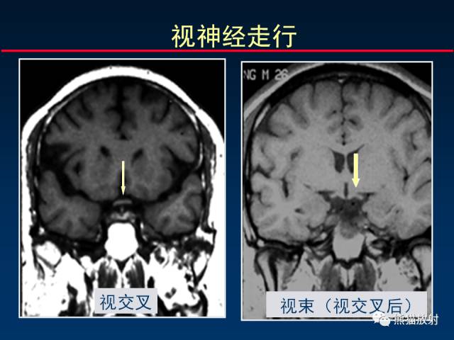 【柳澄讲坛】MR新技术在颅神经研究中的应用