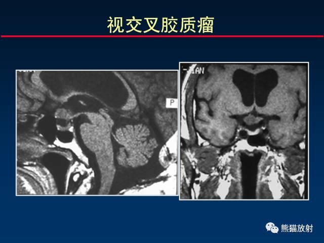【柳澄讲坛】MR新技术在颅神经研究中的应用