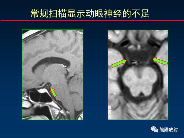 【柳澄讲坛】MR新技术在颅神经研究中的应用