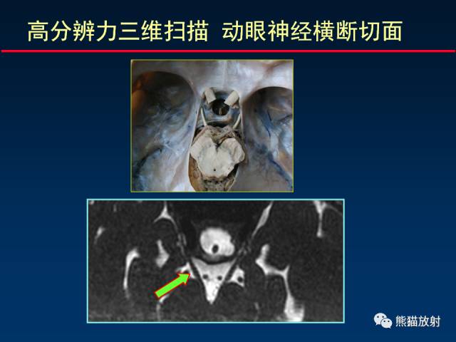 【柳澄讲坛】MR新技术在颅神经研究中的应用