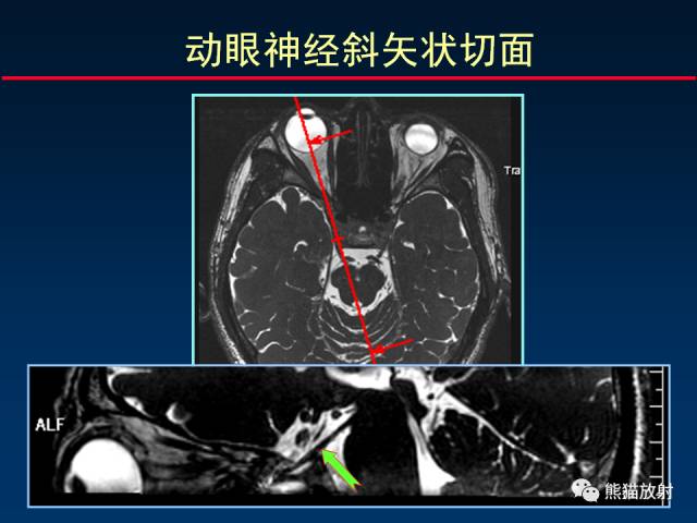 【柳澄讲坛】MR新技术在颅神经研究中的应用
