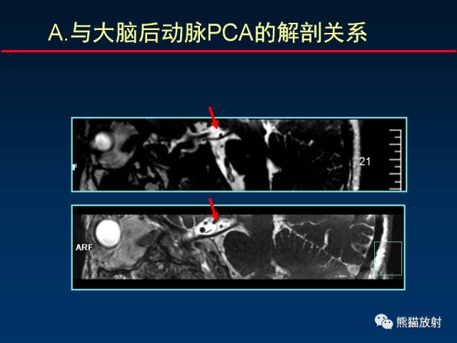 【柳澄讲坛】MR新技术在颅神经研究中的应用