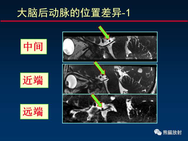 【柳澄讲坛】MR新技术在颅神经研究中的应用