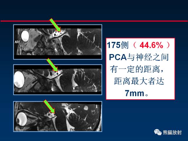 【柳澄讲坛】MR新技术在颅神经研究中的应用