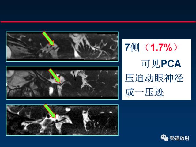 【柳澄讲坛】MR新技术在颅神经研究中的应用