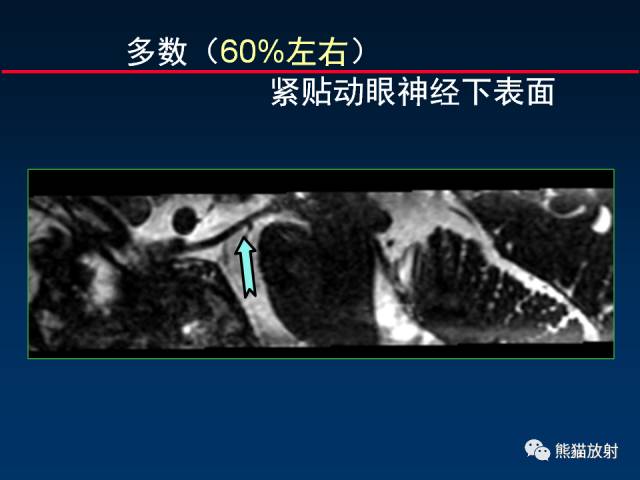 【柳澄讲坛】MR新技术在颅神经研究中的应用